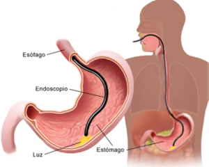 endoscopia