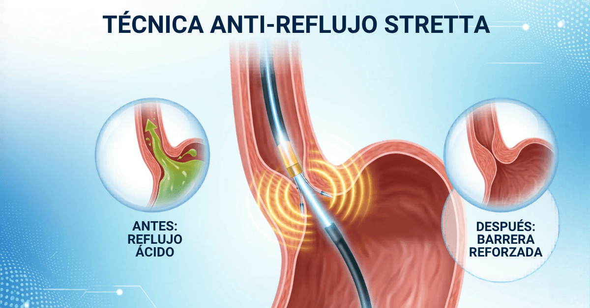 tecnica antireflujo stretta con el dr alberto reyes